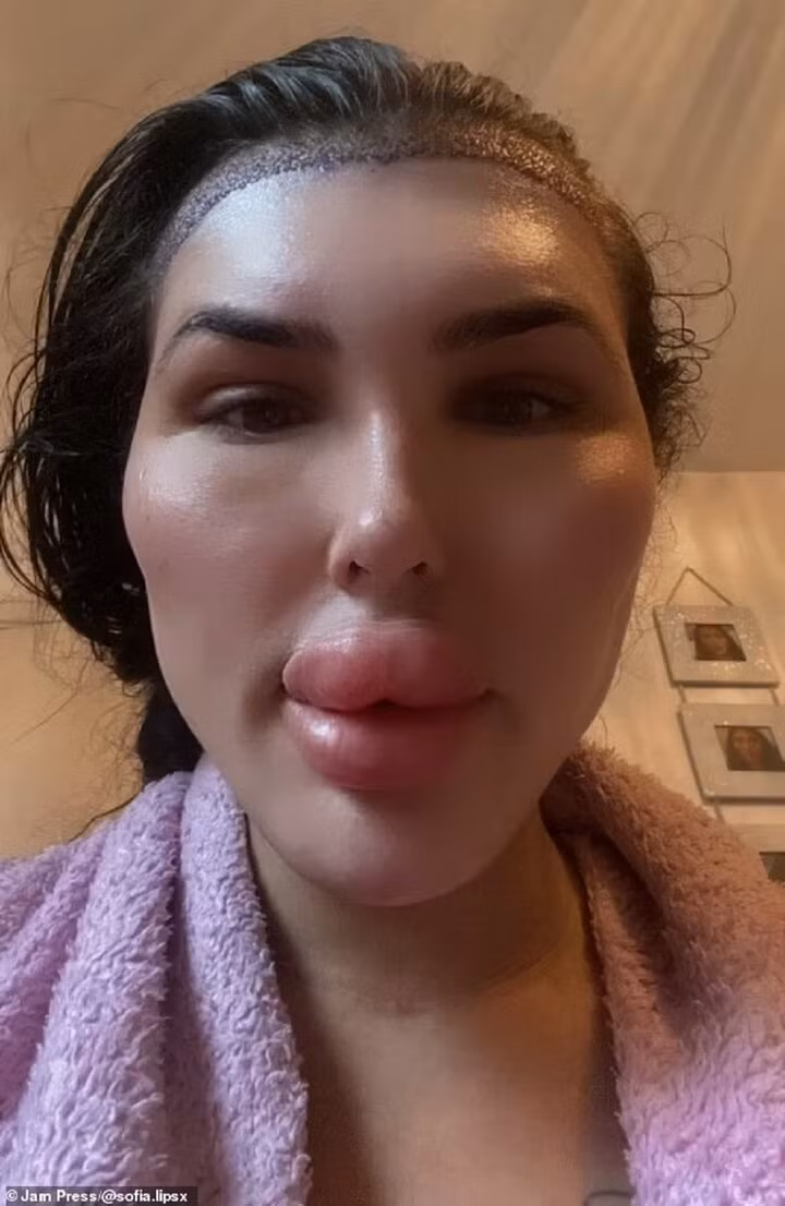 Sofia nói thêm: “Tôi cũng thường xuyên tiêm Botox và tiêm má vì để có được kết quả như ý muốn thì rất tốn kém. Tôi muốn trông giống búp bê tuyệt đỉnh”.