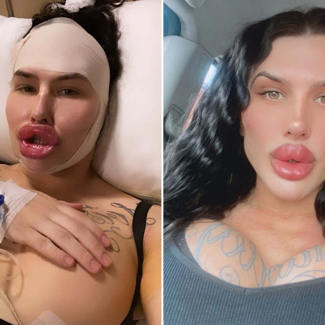 Ngoài đôi môi ấn tượng, Sofia còn trải qua hai lần - sắp tới là ba - nâng ngực, cấy tóc, hút mỡ và sửa mũi, với tổng chi phí phẫu thuật lên tới hơn 500.000 bảng Anh (14,7 tỷ đồng).