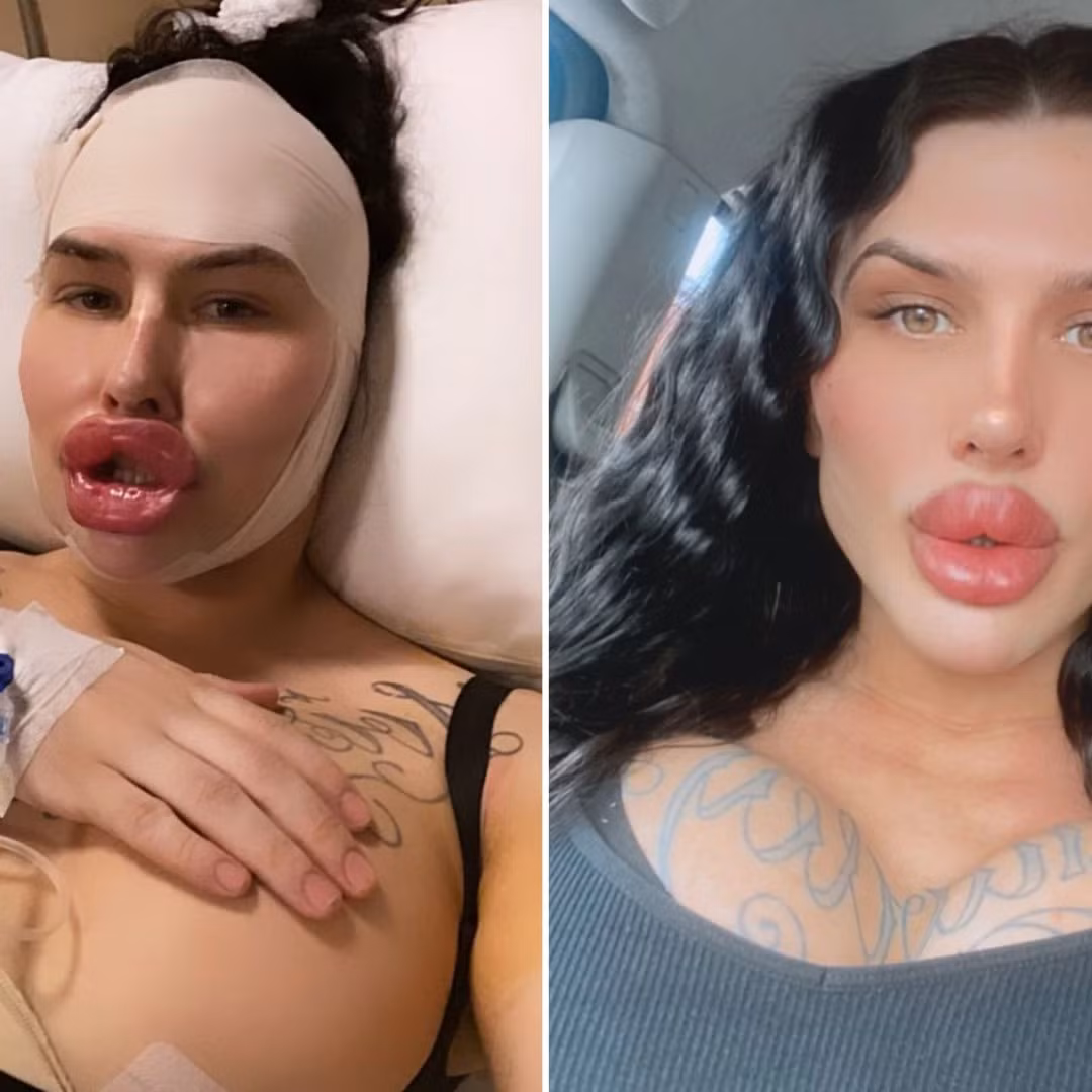 Ngoài đôi môi ấn tượng, Sofia còn trải qua hai lần - sắp tới là ba - nâng ngực, cấy tóc, hút mỡ và sửa mũi, với tổng chi phí phẫu thuật lên tới hơn 500.000 bảng Anh (14,7 tỷ đồng).