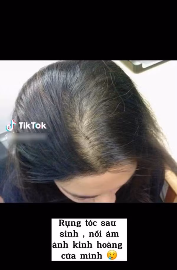 Giống như nhiều “mẹ bỉm” khác, bạn nữ này cũng gặp phải tình trạng rụng tóc sau sinh cùng gương mặt có phần xuống sắc, không đều màu, mũi nở ở giai đoạn cuối thai kỳ.