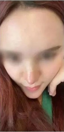 Cũng giống như nhiều hình thức làm đẹp khác, bên cạnh những trường hợp đẹp mĩ mãn thì cũng có không ít người phải gánh chịu hậu quả là chiếc mũi biến chứng vì đặt niềm tin sai chỗ.