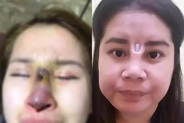 Nhiều người còn bị hoại tử mũi, hay sụn mũn lòi ra khỏi thịt.