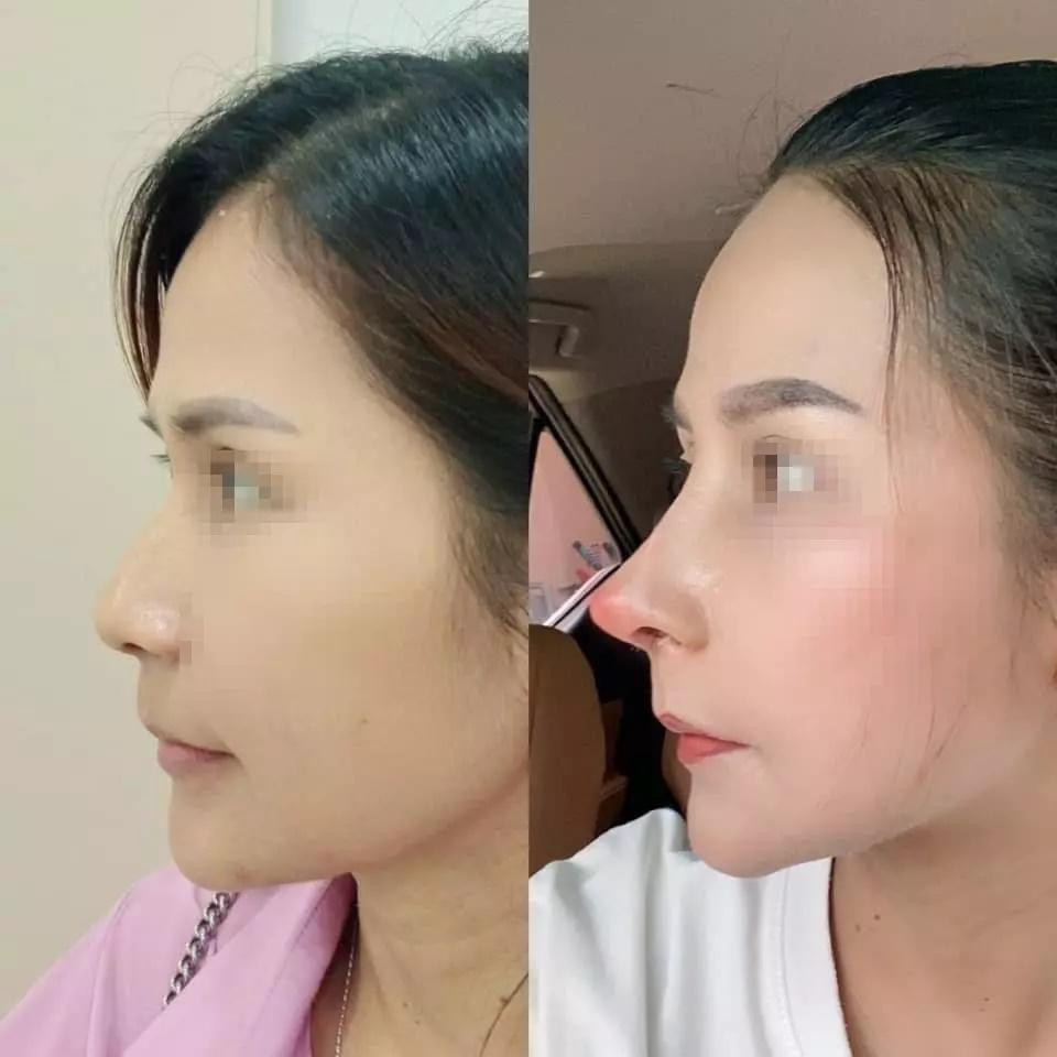 "Đồng ý bay là đẹp mà này bay quá, nhìn khiếp" hay "Quá đỉnh luôn, ai làm cho chị vậy, không có sứng với cái mặt"... là những bình luận được netizen để lại với màn nâng mũi như cầu trượt trên.