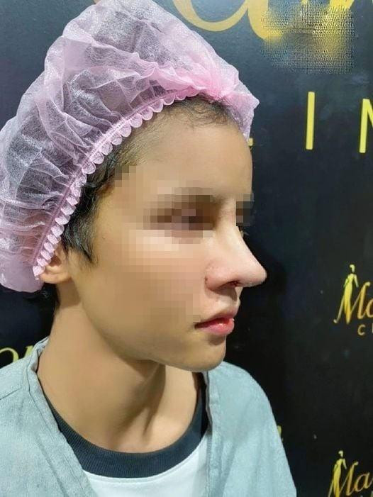 Phẫu thuật nâng mũi là phương pháp làm đẹp được nhiều chị em sử dụng hiện nay bởi không những khiến gương mặt trở nên thanh thoát, đẹp hơn mà còn giúp chủ nhân thay đổi tướng số.