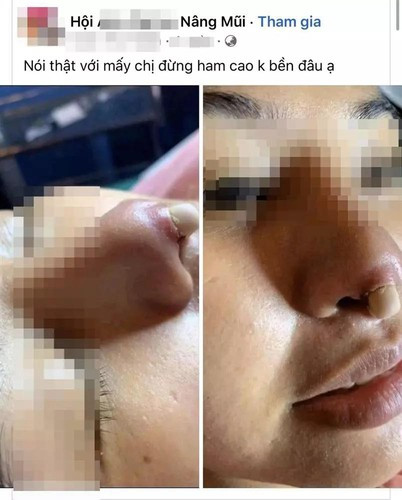 Tuy nhiên, cái gì cũng có hai mặt, có người làm thì đẹp lên nhưng có người lại gặp phải biến chứng.