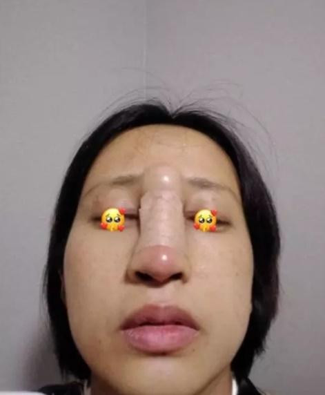 Chiếc mũi sưng vù, nhoi lên tận trán cô gái khiến ai nhìn cũng sốc. Đẹp chẳng thấy đâu chỉ thấy một bầy thương tích.