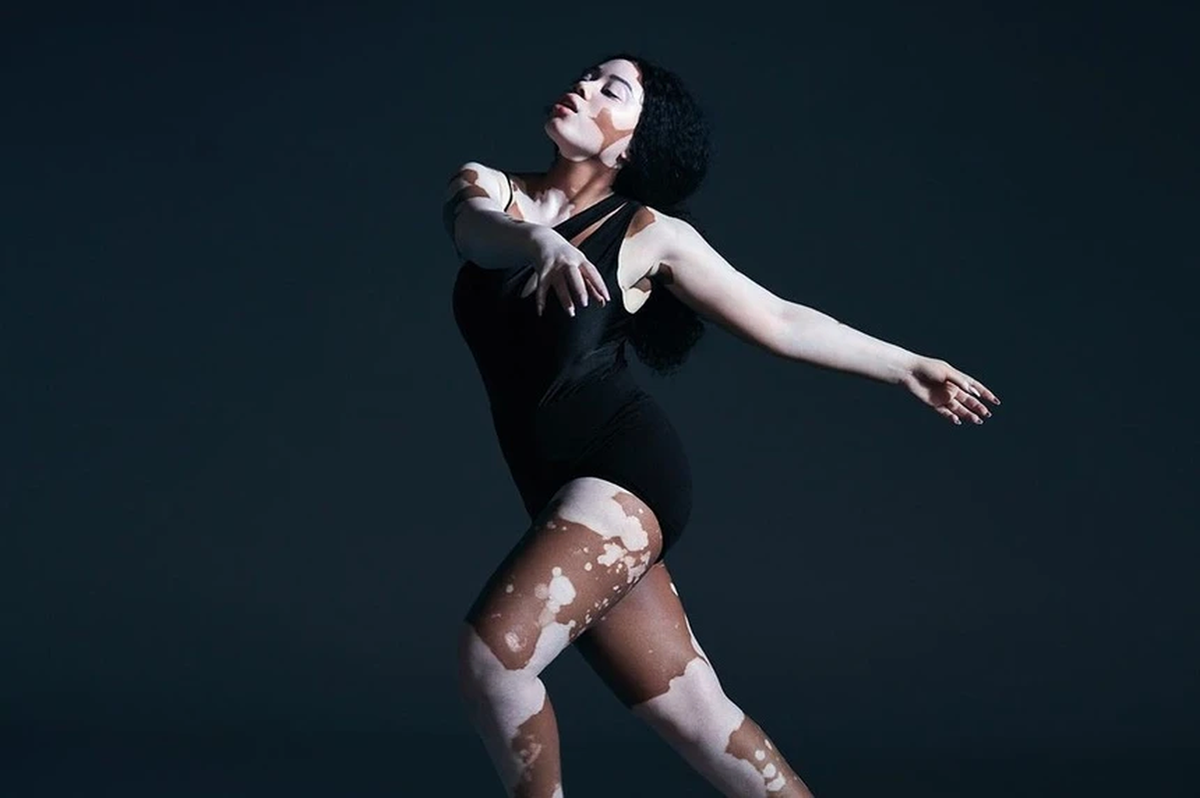 Đến năm 15 tuổi, cô nàng dần suy nghĩ tích cực hơn và không muốn che giấu bản thân thêm nữa. 9X cho rằng những mảng da khác biệt này là điểm nhấn hoàn hảo.