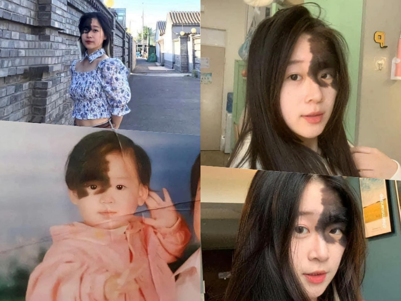 Winnie Harlow là 1 gương mặt nổi tiếng trong làng mẫu thế giới nhờ làn da bạch biến. Cô là một trong những nàng mẫu đắt show nhất hiện tại