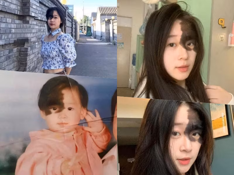 Winnie Harlow là 1 gương mặt nổi tiếng trong làng mẫu thế giới nhờ làn da bạch biến. Cô là một trong những nàng mẫu đắt show nhất hiện tại