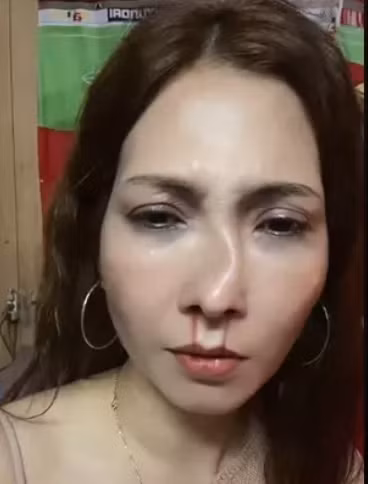 Nhìn chiếc mũi xiêu vẹo, biến dạng, máu trong mũi cũng chảy ra khiến ai nấy đều thất kinh. Sự việc trên sau khi đăng tải đã lập tức hút hơn 4 triệu lượt xem trên nền tảng TikTok.