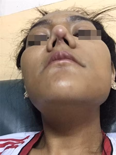 Song đôi khi vì nâng mũi dễ gặp phải nhiều sự cố bất ngờ, hoặc những biến chứng nguy hiểm, thậm chí là mất cả mạng sống.