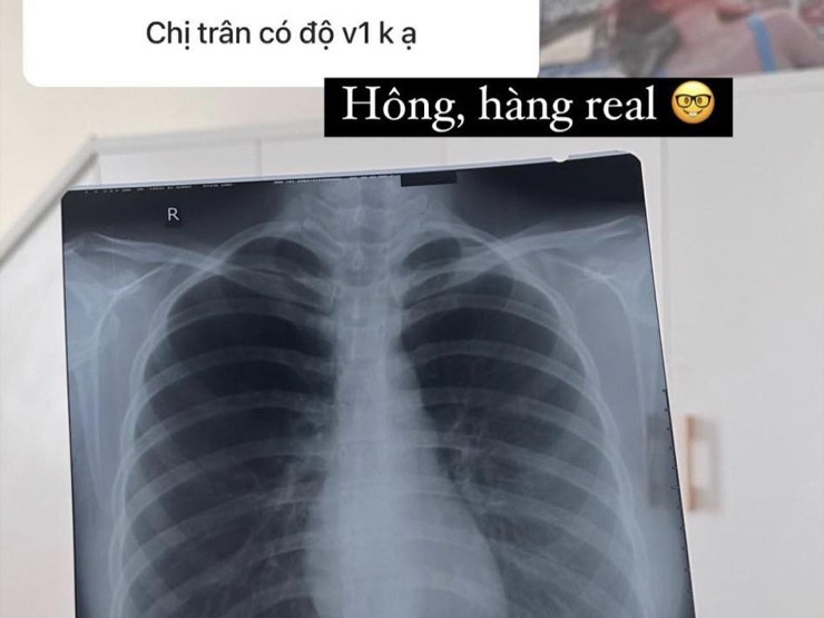 Mới đây, Võ Ngọc Trân đăng tải hình ảnh chụp X-quang để khẳng định vòng 1 đẹp tự nhiên khi được một fan thắc mắc: "Chị Trân có nâng vòng 1 không ạ?".