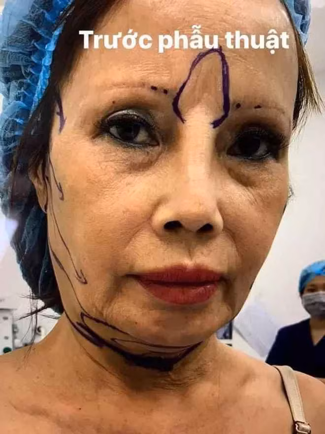 Cách đây 2 năm, cô dâu Cao Bằng gây chú ý khi chia sẻ clip nói về hành trình phẫu thuật thẩm mỹ căng da mặt, cấy mỡ, làm đầu trán với tổng chi phí lên đến 50 triệu đồng.