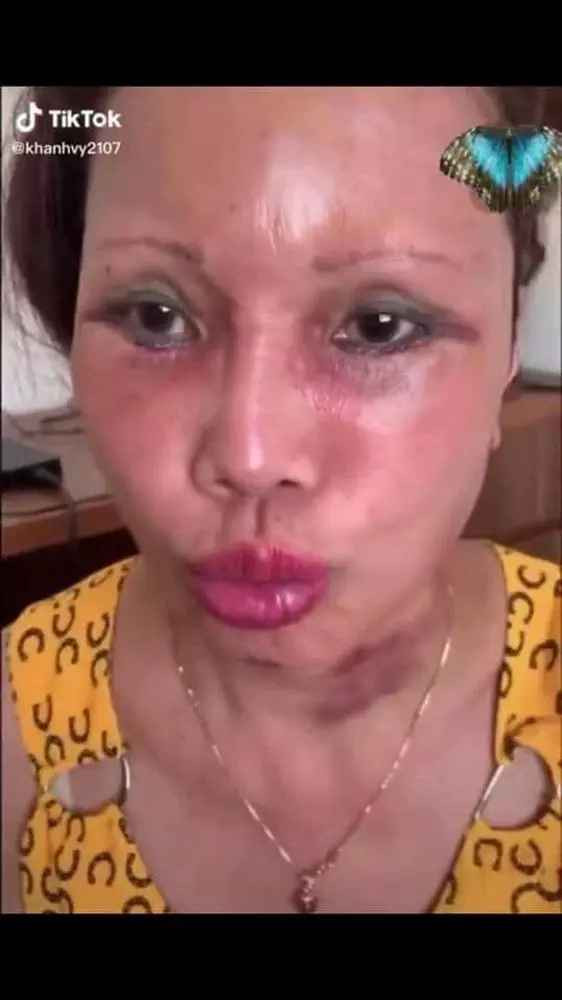 Nhìn video, ngoài bày tỏ phục sát đất trước độ chịu đau, nhiều người cũng lo lắng cho vợ anh Hoa Cương khi "dao kéo" ở tuổi đã cao.