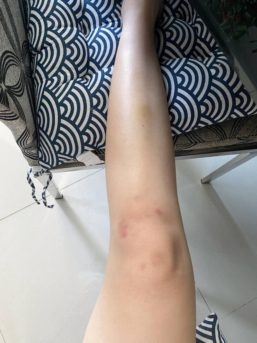 Mới đây, Trâm Anh khiến dân mạng không khỏi lo lắng khi chia sẻ hình ảnh cơ thể bị thương tích, bầm tím từ trán đến tận đầu gối.