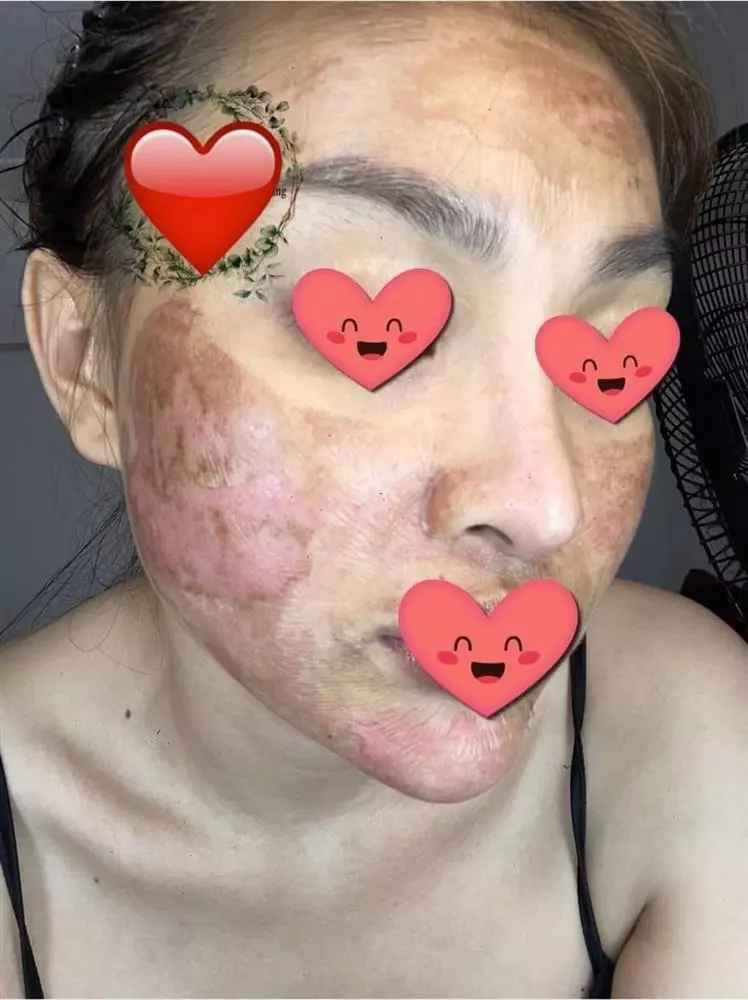 Hình ảnh ghi lại, vị khách hàng xuất hiện với gương mặt loang lổ vết đỏ và đen, làn da nhăn nheo như bị bỏng nặng, trông khá đáng sợ.