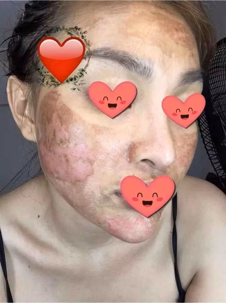 Hình ảnh ghi lại, vị khách hàng xuất hiện với gương mặt loang lổ vết đỏ và đen, làn da nhăn nheo như bị bỏng nặng, trông khá đáng sợ.