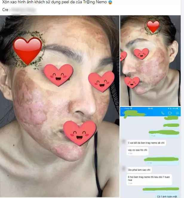 Trên các diễn đàn, cư dân mạng không khỏi xôn xao trước bài viết "feedback" của một cô gái sau khi sử dụng sản phẩm lột da của bên Trang Nemo.