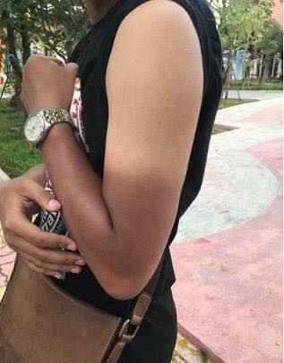 Thậm chí, nhìn những hình ảnh cháy nắng bá đạo này, dân tình còn đùa nhau rằng như bước ra từ phim chưởng và dính phải độc bộ "Huyền minh thần chưởng".