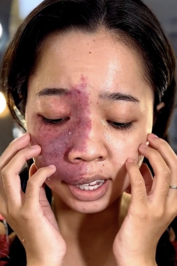 Bất cứ ai có khuyết điểm như thế này trên mặt sẽ cảm thấy không tự tin về bản thân, lúc nào cũng chỉ muốn giấu mặt của mình đi, không tự tin khi giao tiếp, nói chuyện với người khác. Có lẽ vì vậy mà cô gái đã khóc, thể hiện tâm trạng, những cảm xúc mà mình từng phải trải qua.