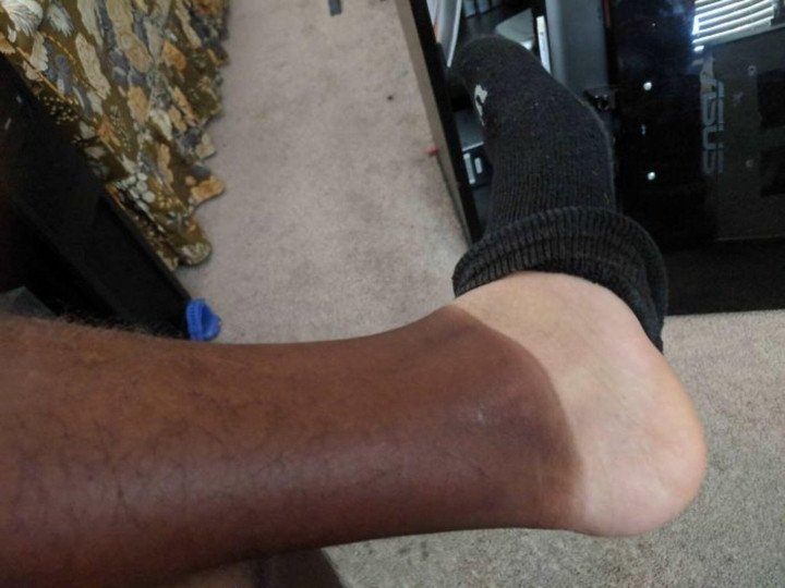 Kể cả có che chắn kỹ lưỡng cỡ nào thì vẫn có những chỗ không thể che tới và đó chính là mục tiêu “ tấn công” của nắng.