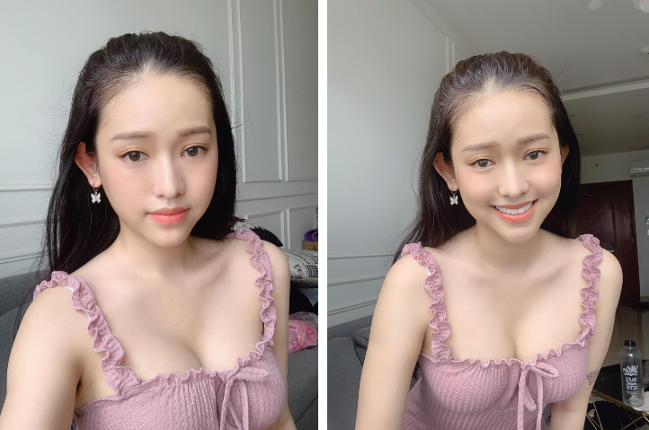 Cách đây đúng 1 năm, hot girl Cà Mau - Thúy Vi khiến dân tình bất ngờ khi đùng đùng tuyên bố đã tháo túi ngực.