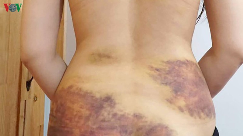 Mot phu nu nghi bi chong bao hanh roi ep quan he tinh duc da man