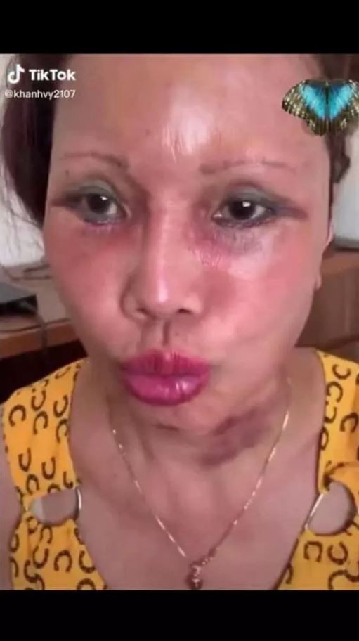 Thế nhưng, tâm điểm chú ý lại thuộc về nhan sắc của chị Thu Sao. Theo đó, sau 3 năm thẩm mỹ, gương mặt chị Sao không thể quay về như hiện trạng ban đầu vì biến chứng.