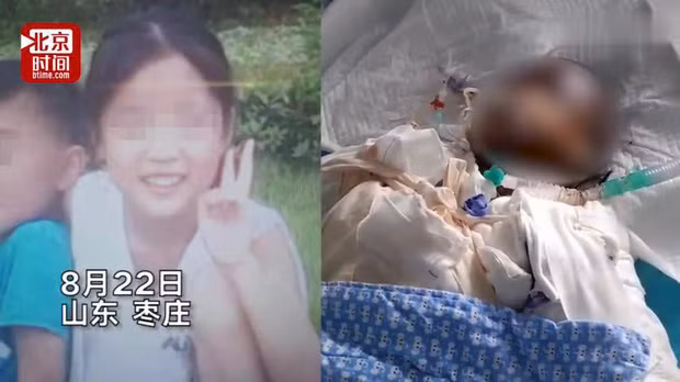 Tuy nhiên, vào khoảng giữa năm 2019, "thánh ăn công sở" Tiểu Dã đã vướng phải vụ lùm xùm liên quan đến việc 2 bé gái là Zhezhe (14 tuổi) và Xiaoyu (12 tuổi) ở tỉnh Sơn Đông (Trung Quốc) bắt chước làm bỏng ngô từ vỏ lon nước, được cho tương tự video cô từng đăng lên mạng xã hội. Hai bé gái đã đun nóng cồn trong 2 lon dẫn tới vụ nổ nghiêm trọng.