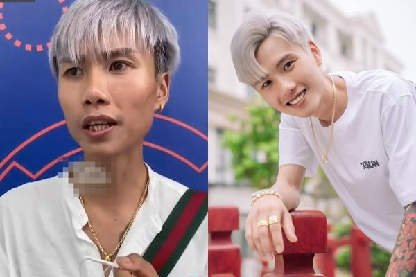 Trước đó, khi tham gia một sự kiện, 9X gây chú ý với gương mặt anh trông khá hóp, làn da sạm đen và nhiều mụn li ti.