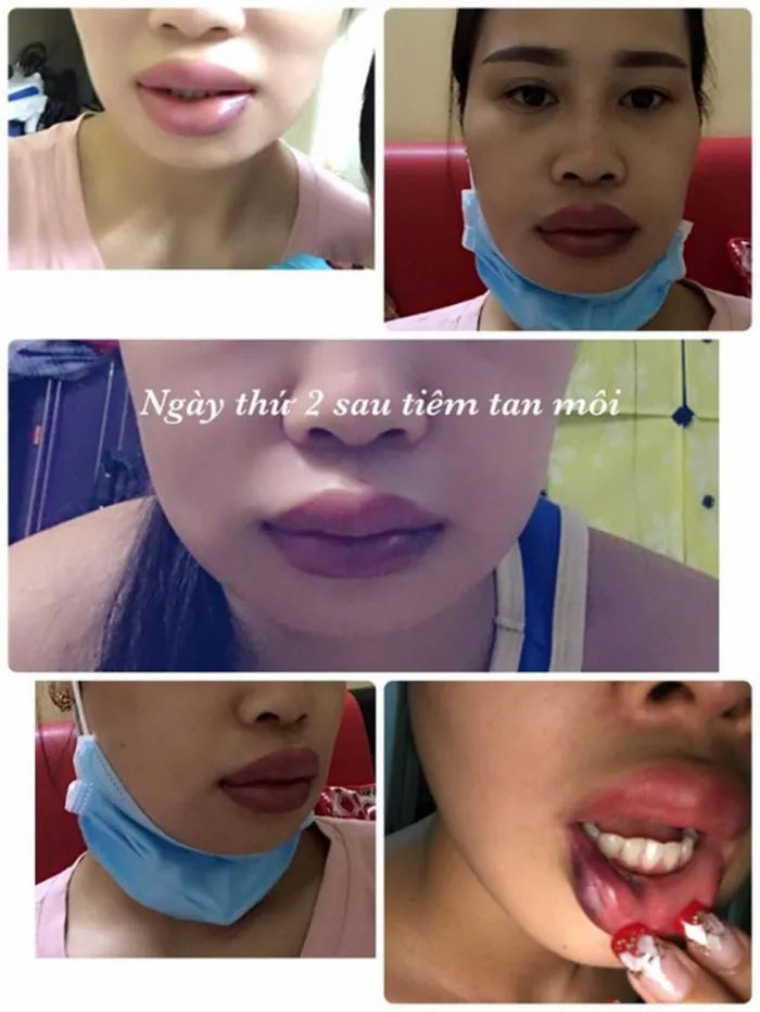 Theo kinh nghiệm của một số chị em trong ngành phun xăm cho hay, tình trạng này rất có thể là phun môi bị cháy tê khiến cho phần da bị tổn thương nghiêm trọng.