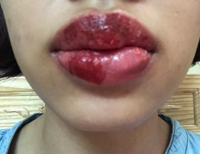 Trên thực tế, cô gái này không phải là "nạn nhân" số nhọ duy nhất gặp phải tình trạng phun môi hỏng.