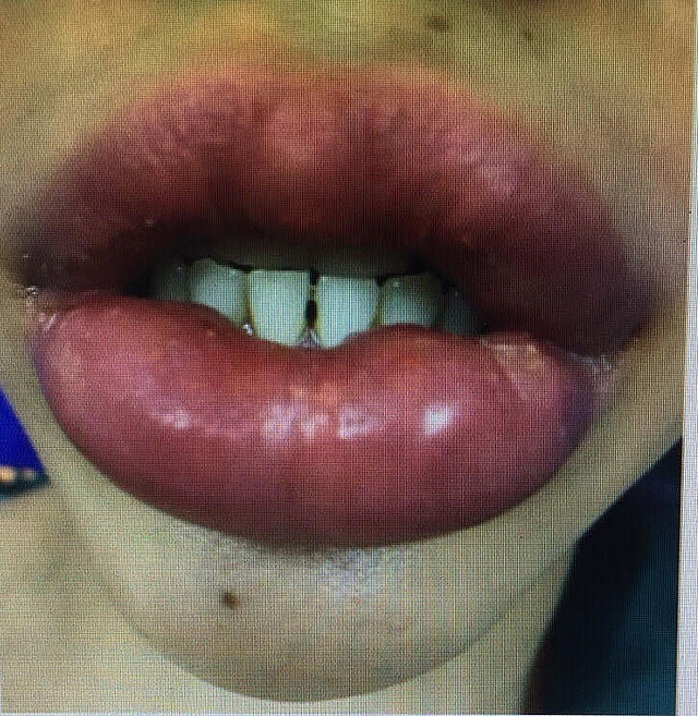 Bên cạnh đó, một số chị em khác thì cho rằng có thể do cơ địa của chính người đi làm cũng như cách họ chăm sóc môi chưa đúng nên mới bị như vậy.