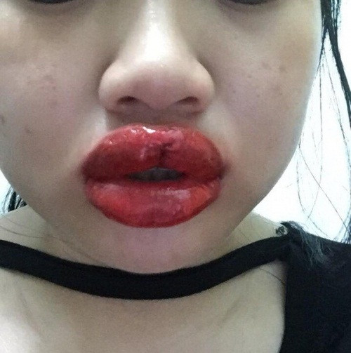 Tuy nhiên, sự thật mới phũ phàng làm sao khi mới thực hiện công cuộc cải tiến nhan sắc được 3 ngày, môi không hề như tưởng tượng mà lại khô nứt, chảy máu tụ lại đen xì.