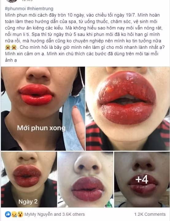 Theo như chính chủ đăng tải, nghe nói dạo này chị em đang rầm rộ trào lưu phun môi collagen khá hot nên cô nàng cũng thử.