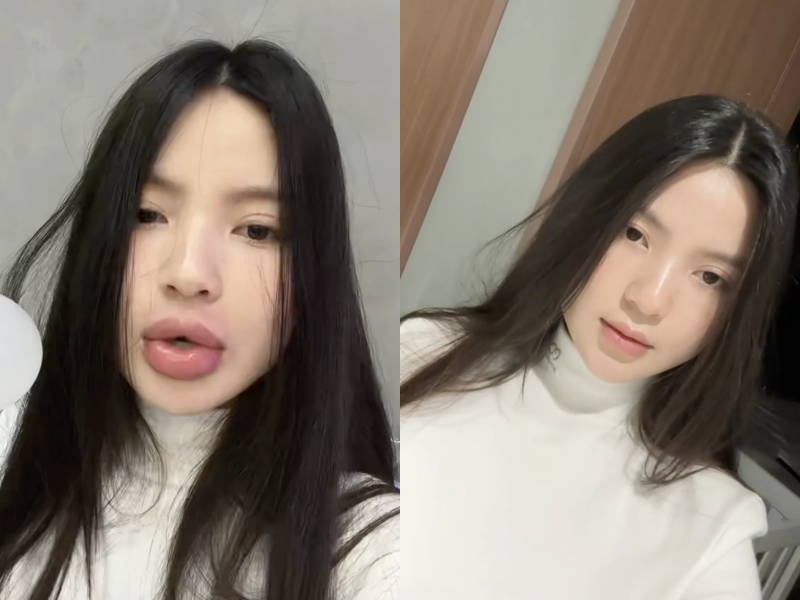 Quang Hải sau đó đã khuyên bà xã nên đi tiêm tan môi để lấy lại hình dáng môi như ban đầu.