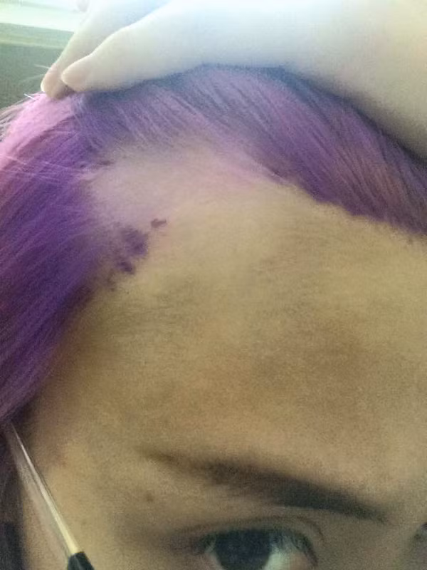 Cần phải hiểu rằng tẩy tóc là một kĩ thuật phức tạp và ảnh hưởng rất nhiều đến tóc. Nếu thợ làm tay nghề chưa cao, thực hiện không đúng cách có thể khiến lớp biểu bì trên tóc bị vỡ, từ đó chất tóc trở nên xốp, dễ bị xơ rối, gãy rụng.