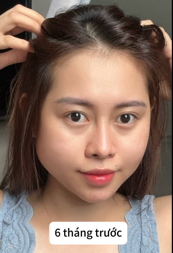 Năm 2017, khi này Việt Phương Thoa có gương mặt hóp và cằm chẻ, cô mong muốn đi tiêm filler để gương mặt baby và đầy đặn hơn, có nhiều cơ hội phát triển trong nghề nghiệp.