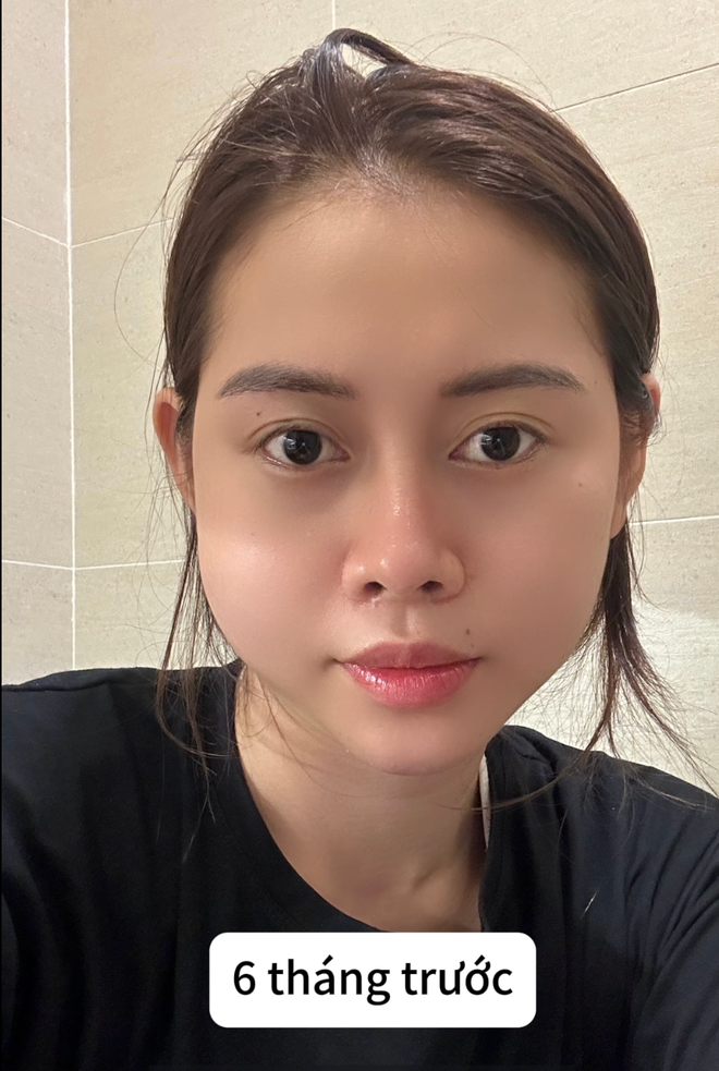 Vậy nên khi gặp phải tình trạng này, Việt Phương Thoa đã đăng tải quá trình chạy chữa của mình để gửi lời cảnh tỉnh cho mọi người phải chọn cơ sở PTTM uy tín.