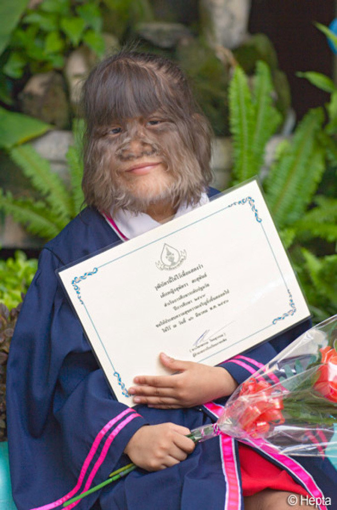 Vì vẻ ngoài khác biệt của mình so với bạn bè cùng trang lứa, thế nên Supatra Sasuphan gặp nhiều khó khăn trong việc hòa nhập với cộng cồng và mọi người xung quanh.