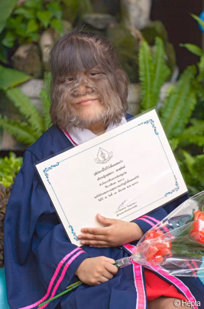 Vì vẻ ngoài khác biệt của mình so với bạn bè cùng trang lứa, thế nên Supatra Sasuphan gặp nhiều khó khăn trong việc hòa nhập với cộng cồng và mọi người xung quanh.