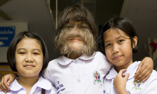 việc Supatra Sasuphan mắc phải căn bệnh "người sói" cũng chẳng thể chữa trị được, phải sống cả đời với thân hình nhiều lông như vậy.