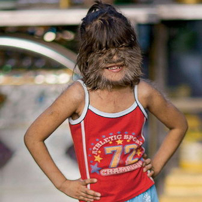 Dù cho có thử qua các phương pháp triệt lông tiên tiến để có thể làm chậm lại quá trình phát triển lông mặt nhưng Supatra Sasuphan vẫn không hiệu quả.