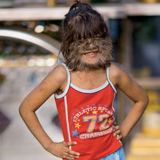 Dù cho có thử qua các phương pháp triệt lông tiên tiến để có thể làm chậm lại quá trình phát triển lông mặt nhưng Supatra Sasuphan vẫn không hiệu quả.