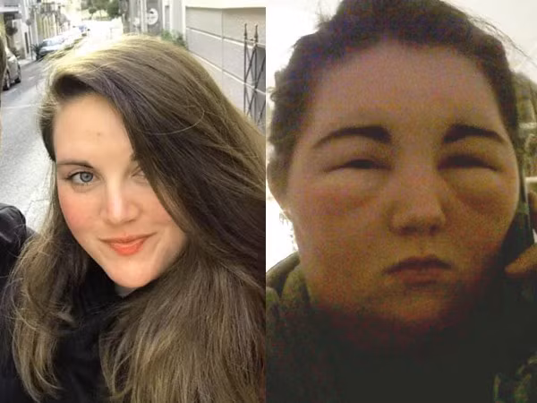 Phản ứng dị ứng này khiến khuôn mặt Seraya sưng phồng lên méo mó, đôi mắt sưng húp lại và thị lực bị ảnh hưởng.