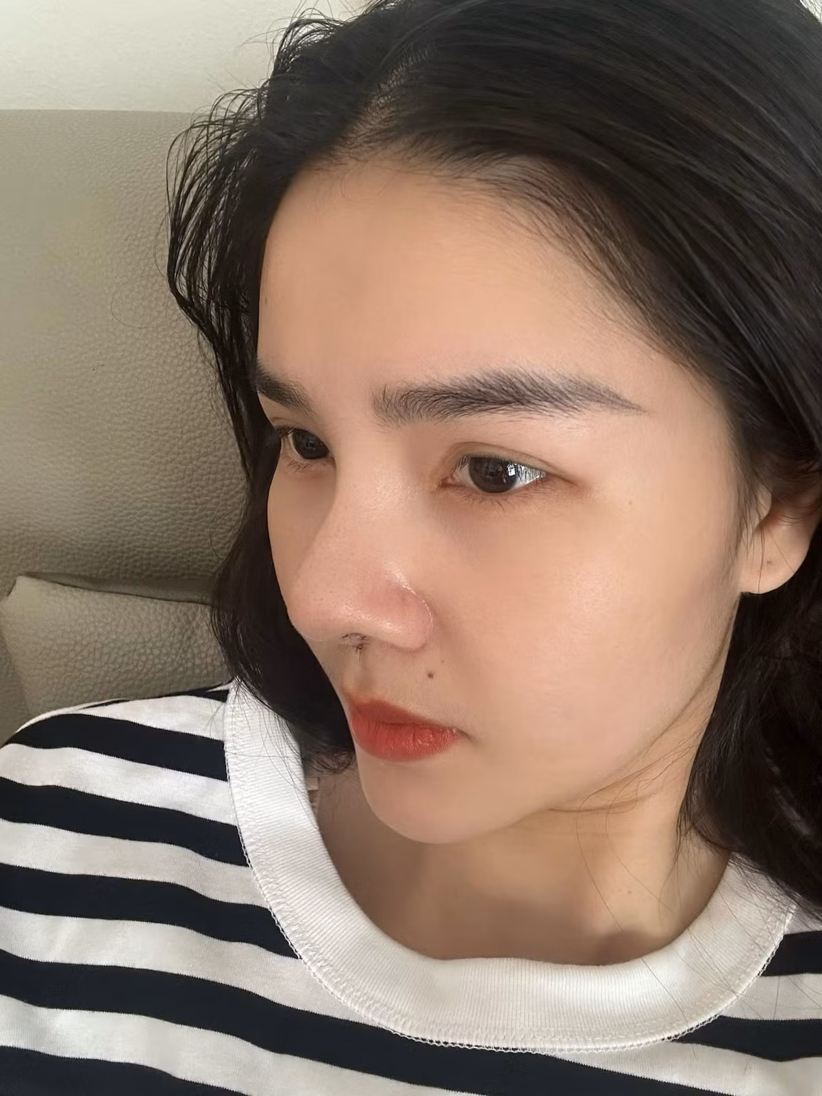 Kỳ Hân cho hay đây là thứ 4 cô can thiệp dao kéo vùng mũi, chi số tiền lên đến gần 90 triệu đồng, bao gồm chi phí sụn mới và tháo sụn cũ.