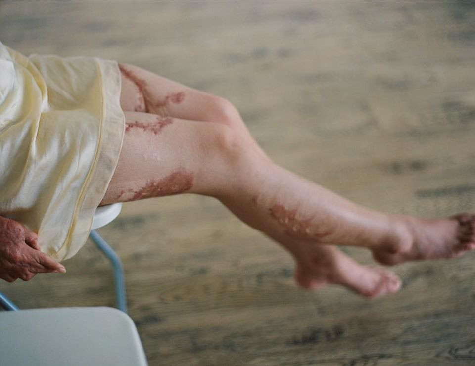 Vụ tai nạn kinh hoàng đã khiến Châu Nham bỏng 28%, nhiều nơi trên cơ thể bỏng cấp độ 3, tay chân bị tổn thương nghiêm trọng. Sự tàn độc của gã công tử nhà giàu đã cướp đi mọi giấc mơ của cô nữ sinh 16 tuổi.