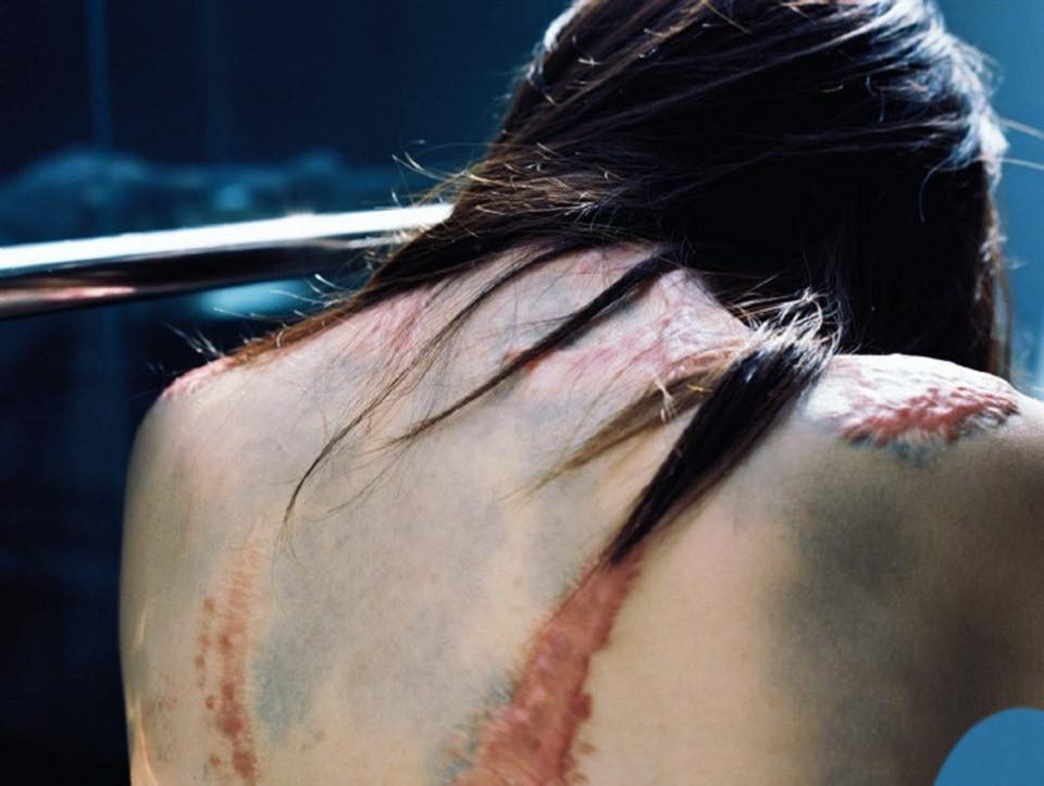 Để có được như hình hài như ngày nay Châu Nham đã trải qua hàng chục cuộc phẫu thuật để cấy ghép da và trị liệu. Nhưng có lẽ nỗi đau về thể xác không khủng khiếp bằng nỗi đau tinh thần mà cô gái trẻ phải chịu đựng trong suốt thời gian dài.