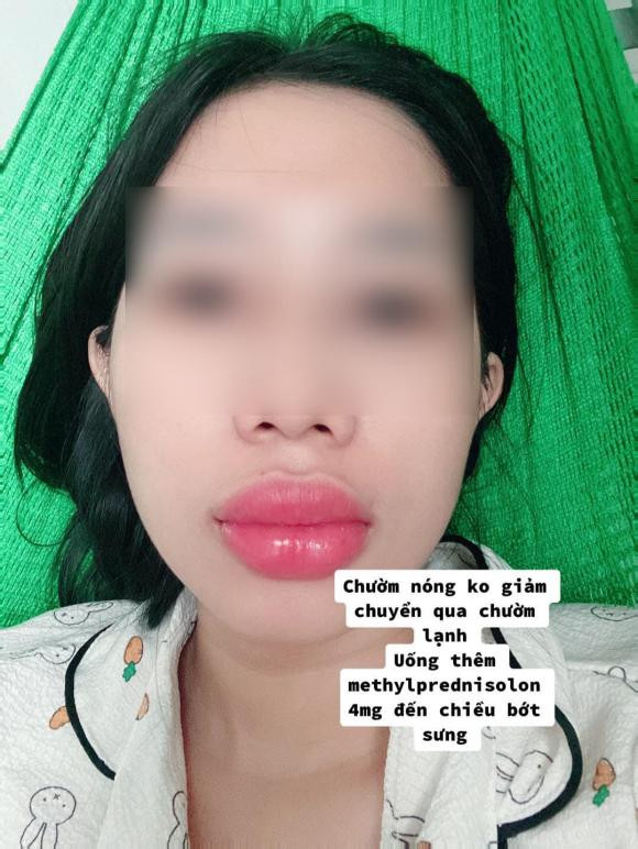 Theo các chuyên gia thẩm mỹ, việc làm trẻ hóa hay tạo hình bằng các chất làm đầy trở nên phổ biến của các tín đồ làm đẹp nhờ vào hiệu quả tức thì, ít đau đớn và gần như không cần thời gian nghỉ dưỡng.