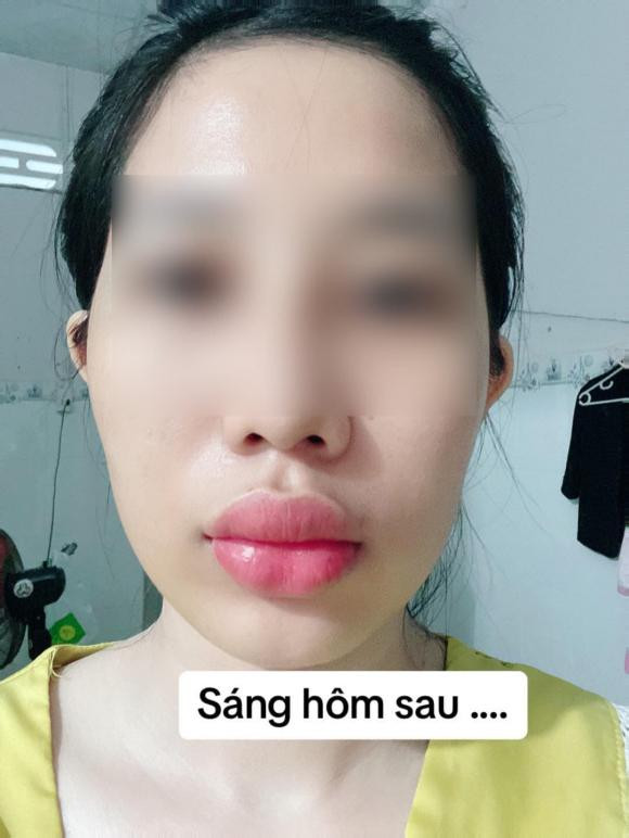 Sau khi tiêm, có thể gặp một số biểu hiện như sưng nhẹ, đỏ nhẹ, có thể có vết bầm là những biểu hiện bình thường và thường sẽ tự biến mất sau vài giờ hay vài ngày.